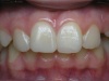 Реставрации передних зубов
